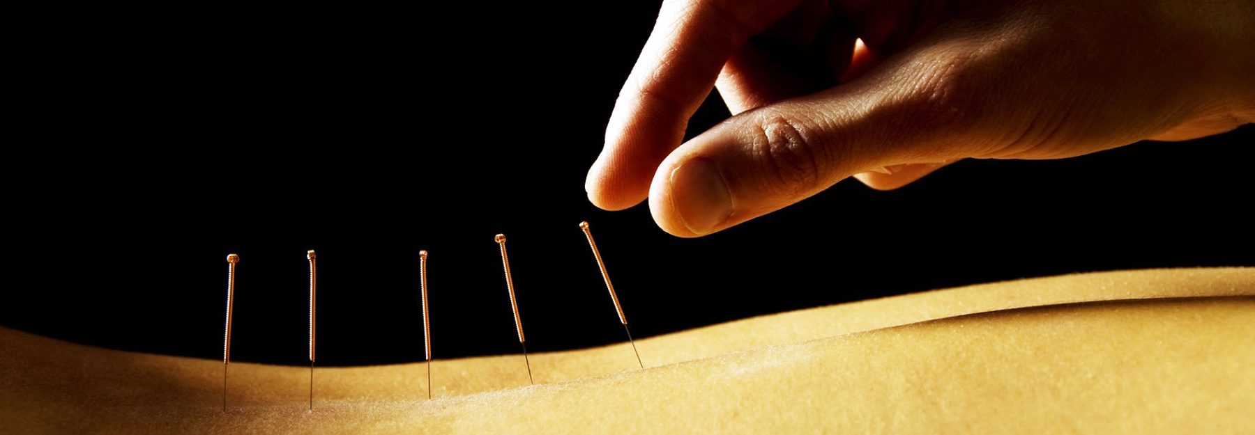 acupuntura