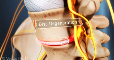 sciatica-disc-degeneration